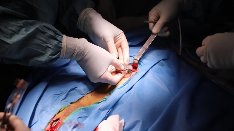 L'Hospital Germans Trias és el primer centre estatal en implantar un dispositiu que pal·lia els efectes del Parkinson