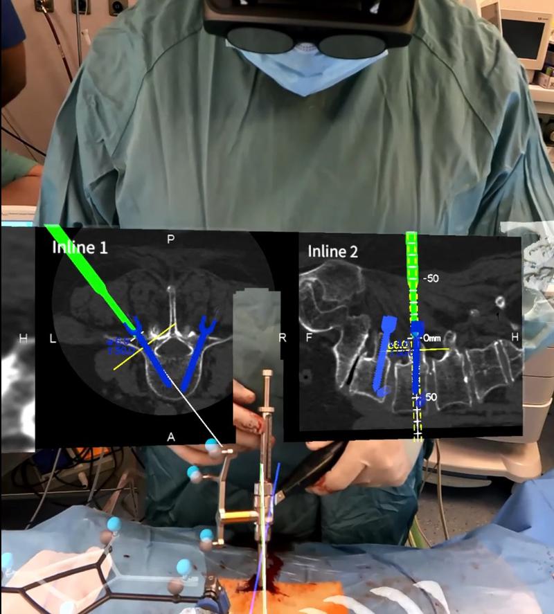 cirurgia columna 2