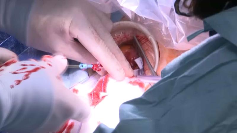 Segon quiròfan híbrid a l'hospital Germans Trias: les operacions a cor obert, per a la història
