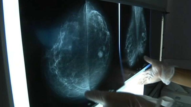 Avenç científic d'IrsiCaixa contra un dels càncers de mama més agressius, el triple negatiu