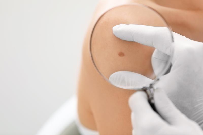 Els casos de melanoma creixen un 7% cada any, segons l'ICO de Badalona