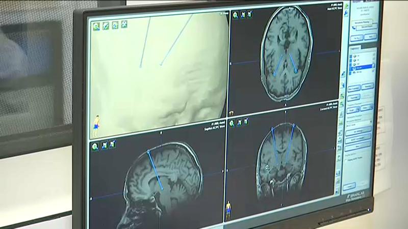 L'Hospital Germans Trias i Pujol detecta alteracions cerebrals en pacients amb migranya crònica